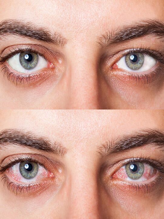 antes e depois do tratamento com gotas de Oculear