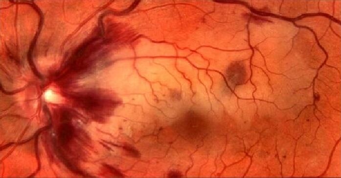 vasos sanguíneos da retina e restauração da visão